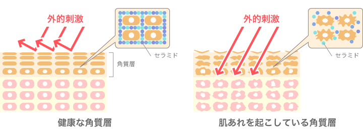 健康な角質層・肌あれを起こしている角質層