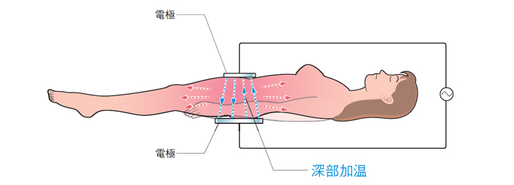 インディバのしくみ