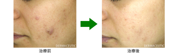 ミルクピール トリートメント写真