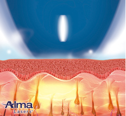 ソプラノアイス チタニウム