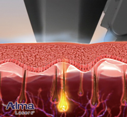 ソプラノアイス チタニウム