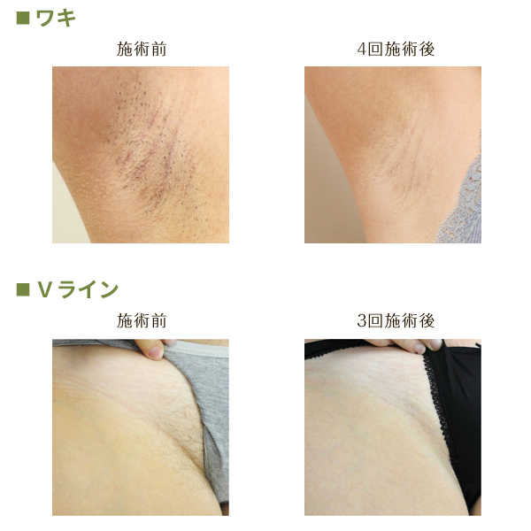 レーザー脱毛の原理