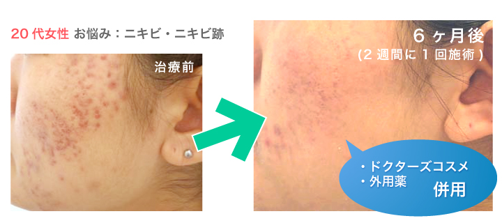 ダブルピーリング（ケミカルピーリング症例